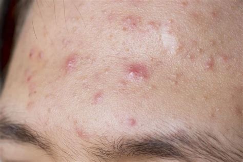 8 Common Skin Problems And How To Fix Them How To Remove Pimples