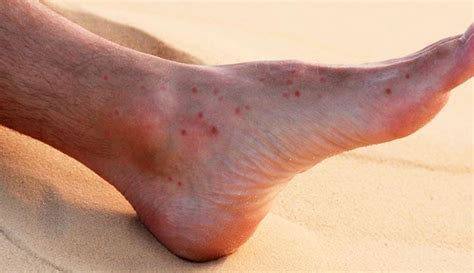 Sand Flea Bites Photos Diagnosis Causes Risk And Treatments