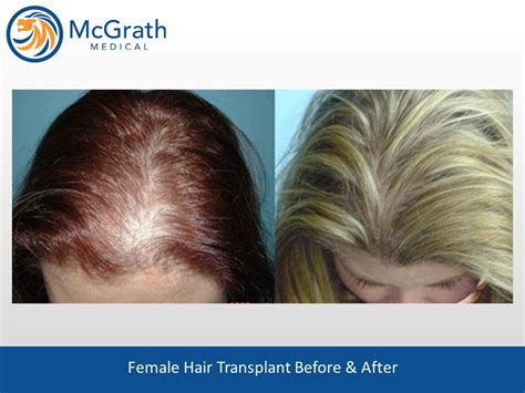Female Fue Hair Transplant Before And After Jetta Mccullough