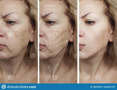 Woman Face Wrinkles Removal Therapy Dermatology Before And After