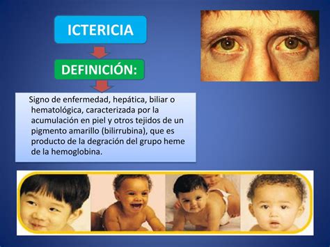 Ppt Ictericia Powerpoint Presentation Free Download Id5591767
