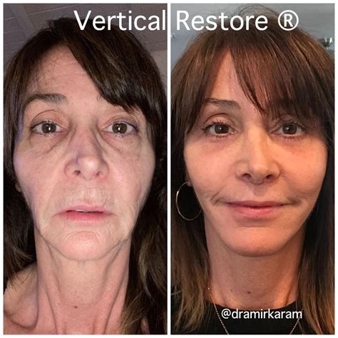 Amir M Karam MD On Instagram To Say Vertical Restore Facial Rejuvenation Is Life Changing Is