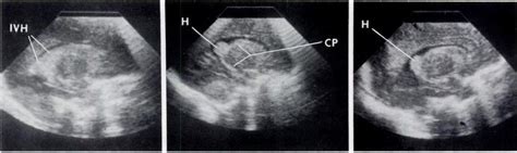 A Resolution Of Intraventricular Hemorrhage Ivh Sagittal Scan