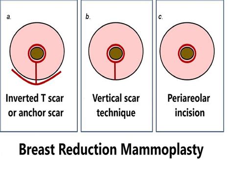 Breast Reduction Mammoplasty In India