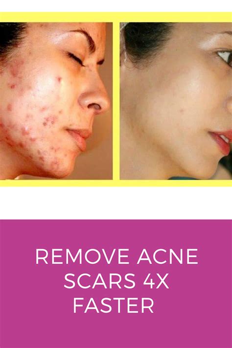 How To Help Acne Scars Heal Faster Heal Info