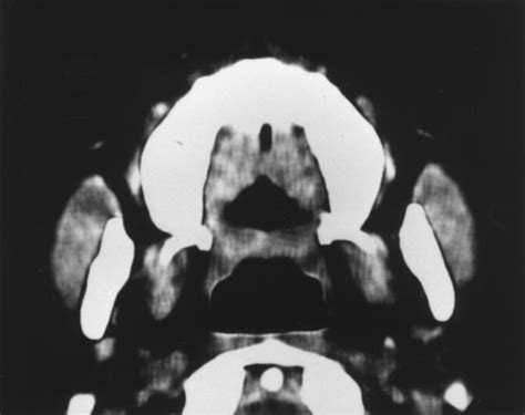 Image Processing Sequence Used For Measurements Of The Masseter Muscle