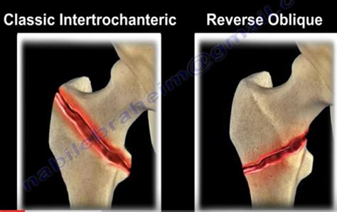 Reverse Oblique Trochanteric Fracture —