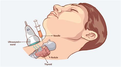 Covid Defer Bread And Butter Procedure For Thyroid Nodules