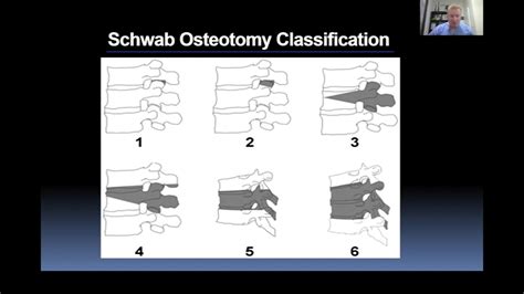 Osteotomies Posterior Column Releases With Stu Hershman Md Johnson