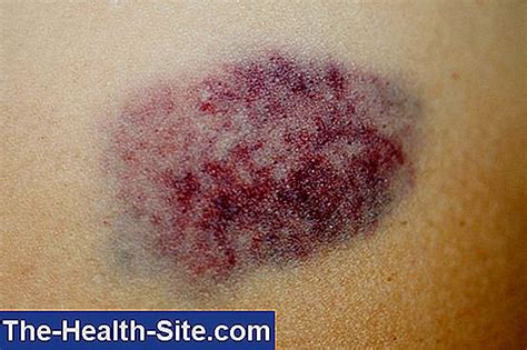 Bruises 💊 Scientific Practical Medical Journal 2023