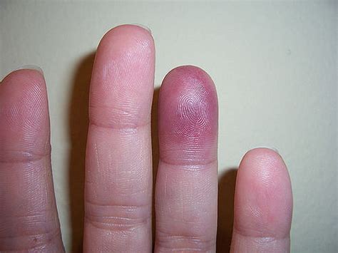 Finger Bruising Recurrent Spontaneous Pain Medical Musing