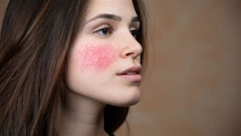Facial Redness Causes Symptoms And Treatments