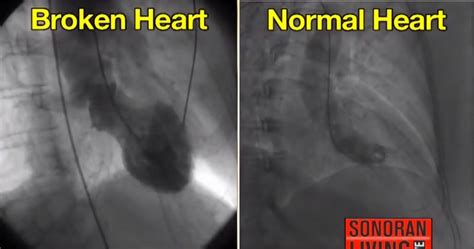 Broken Heart Syndrome Is A Real Physical Thing Doctors Say