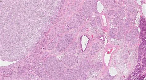 Epithelial Myoepithelial Carcinoma Of The Salivary Glands Atlas Of