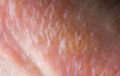 Clear Bumps On Skin