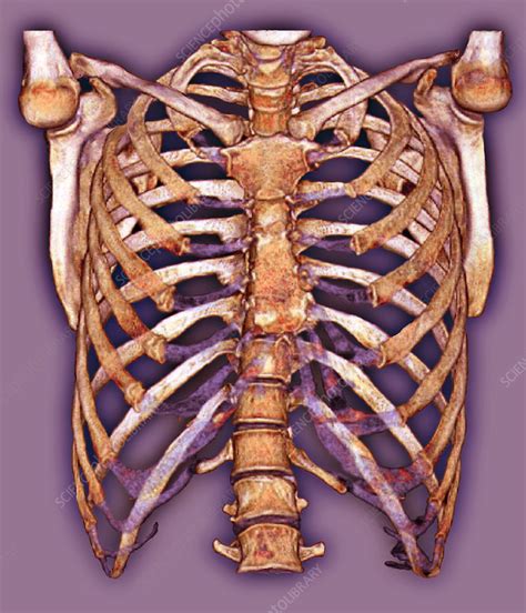 Rib Cage Back Pain And Slipped Rib The Rib Cage Is Formed By The