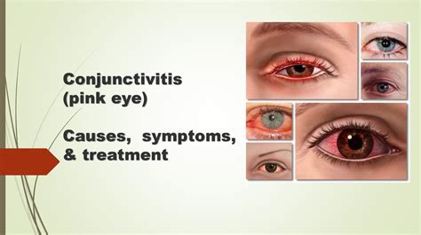 Conjunctivitis Pink Eye Causes Symptoms And Treatment Online