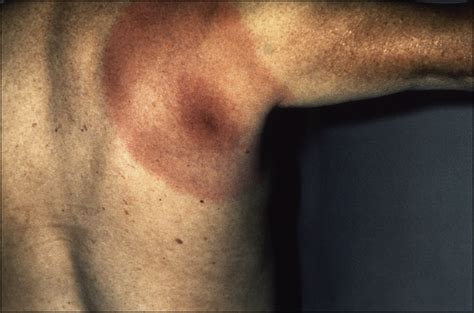 Not All Erythema Migrans Lesions Are Lyme Disease The American