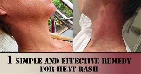 Skin Heat Rash Cure