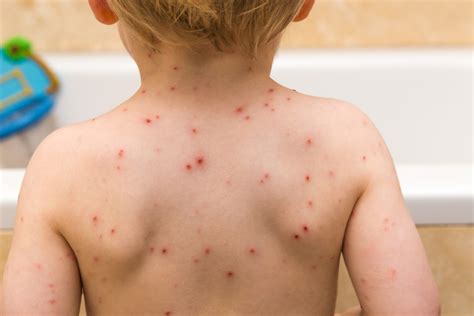 What Is My Childs Rash How To Identify 10 Rashes And Tell If Theyre
