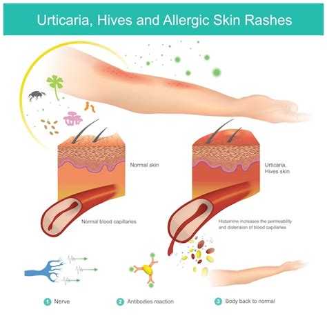 Premium Vector Urticaria Hives And Allergic Skin Rashes Is A Kind Of