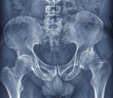 Osteoarthritis Of The Hip X Ray Stock Image F0063744 Science
