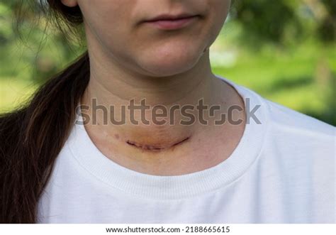 Scars On Woman Neck Thyroid Images Stock Photos Vectors