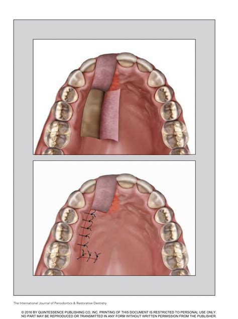PDF Soft Tissue Closure Of Grafted Extraction Sockets In The Anterior