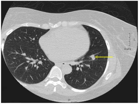 A 13 Cm × 08 Cm Nodule In The Left Lung Lower Lobe Download