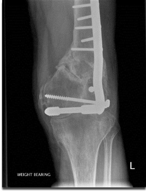 Knee Arthrodesis With Lengthening Experience Of Using Ilizarov