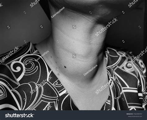 Anterior Neck Swelling Known Medically Goitre Stock Photo 1762399757