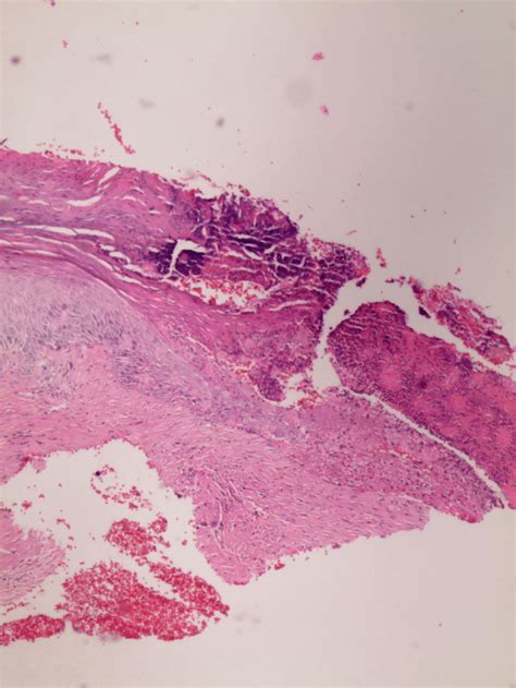 Epidermal Ulceration And An Abscess Formation Under The Parakeratotic
