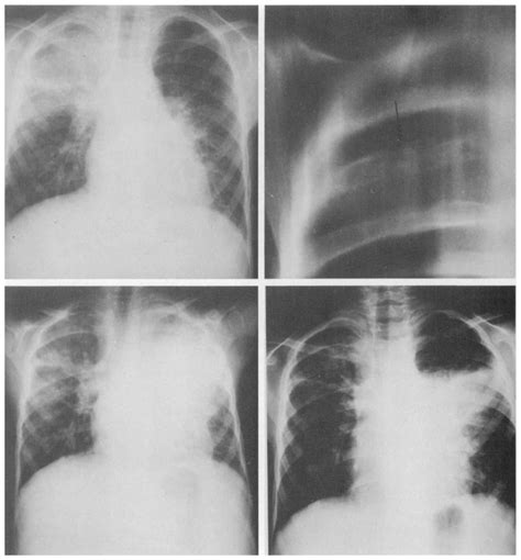 Upper Left Chest X Ray On Admission Prominent Right Upper Lobe