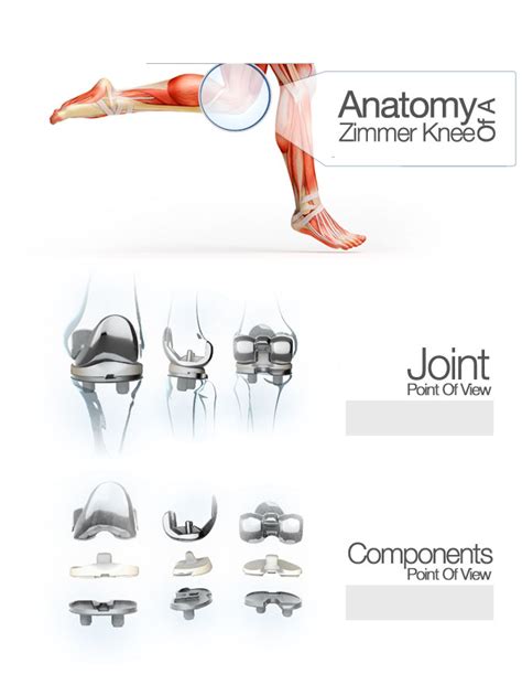 Anatomy Of A Zimmer Knee Replacement Naples Orthopedic Doctor Leon