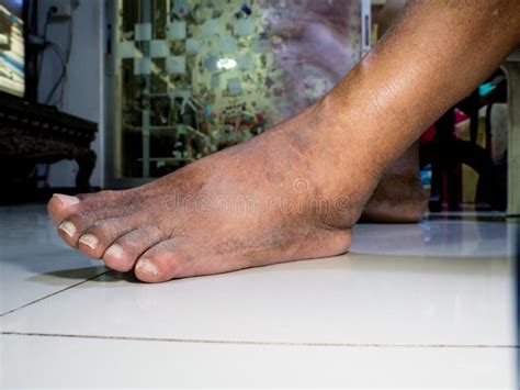 The Feet Of People With Diabetes Dull And Swollen Stock Photo Image