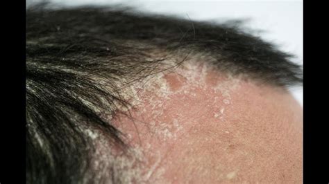 The Perfect Treatment For Psoriasis Of The Scalp Youtube
