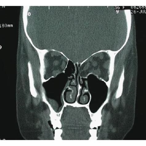 Coronal CT Scan Shows Fat Herniation Into Ethmoid Sinus After Download Scientific Diagram