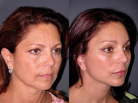 Mini Facelift Before And After Dr Andrew Jacono Facelift Face
