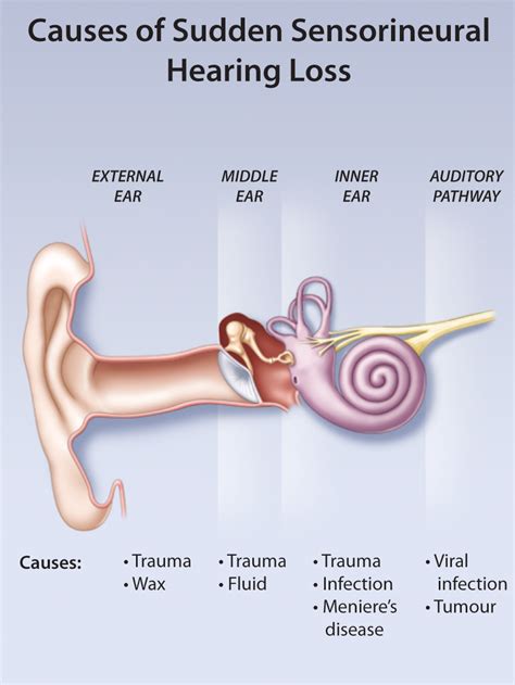 Sensorineural hearing loss is characterized by the gradual attenuation of the intensity of sound. Indications for Hyperbaric Oxygen Therapy - Idiopathic ...