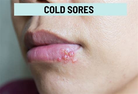 Cold Sores Vs Canker Sores Pictures And Differences