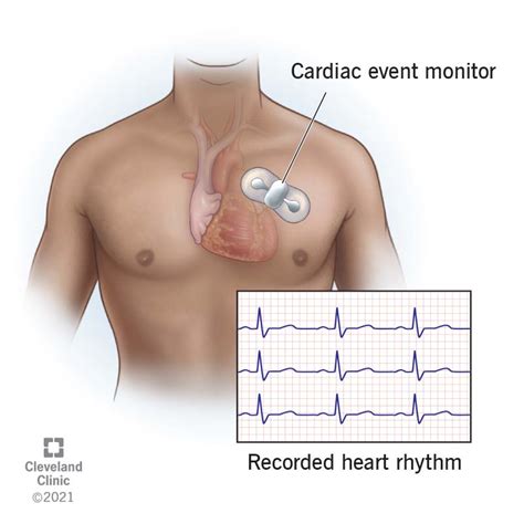 Cardiac Event Monitor Types And Uses