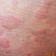 Allergic skin reactions are the most common symptoms of egg allergy. What food allergies can cause itchy skin
