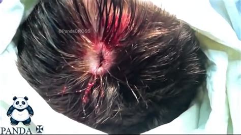 Remove Large Cyst On Scalp Youtube