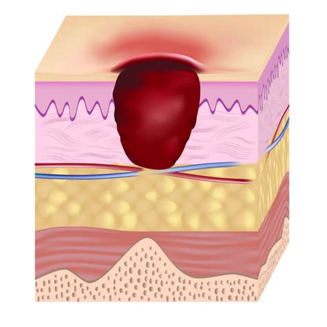 Stage 3 Wound Pressure Ulcers Prevention Evaluation And Management