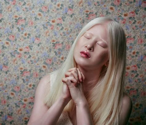 An Albino Girl Who Was Abandoned As A Baby Grows Up To Be A Vogue Model