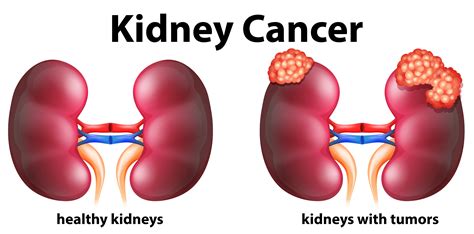 Cancer Kidneys Symptoms Signs And Symptoms Of Kidney Cancer Learn
