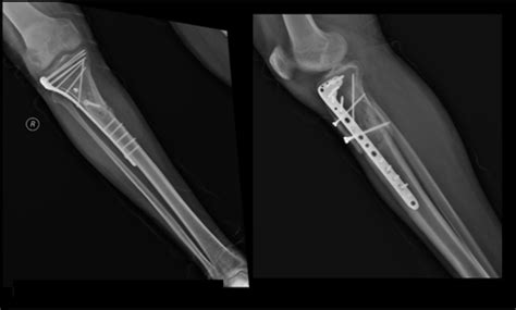 Malunited Proximal Third Tibia Fracture Treated With Open Reduction And