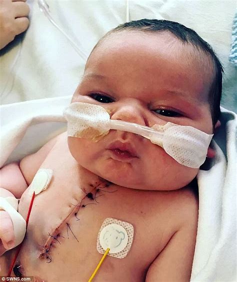 Baby Born With Half A Heart Survives Surgery At Days Old Goes Home At Last Daily Mail Online