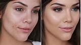 Makeup To Cover Acne