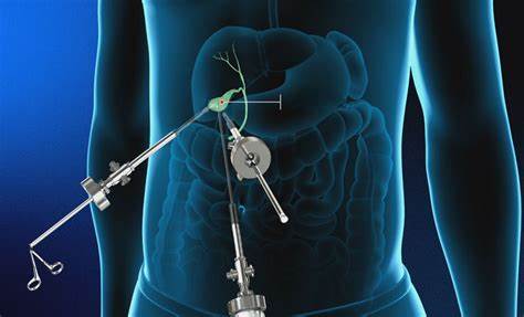 Лапароскопия желчного пузыря диета после 5 стол после удаления желчного пузыря лапароскопия - 94 фото 5 стол после удаления желчного пузыря лапароскопия - 94 фото Лапароскопия желчного пузыря диета после
